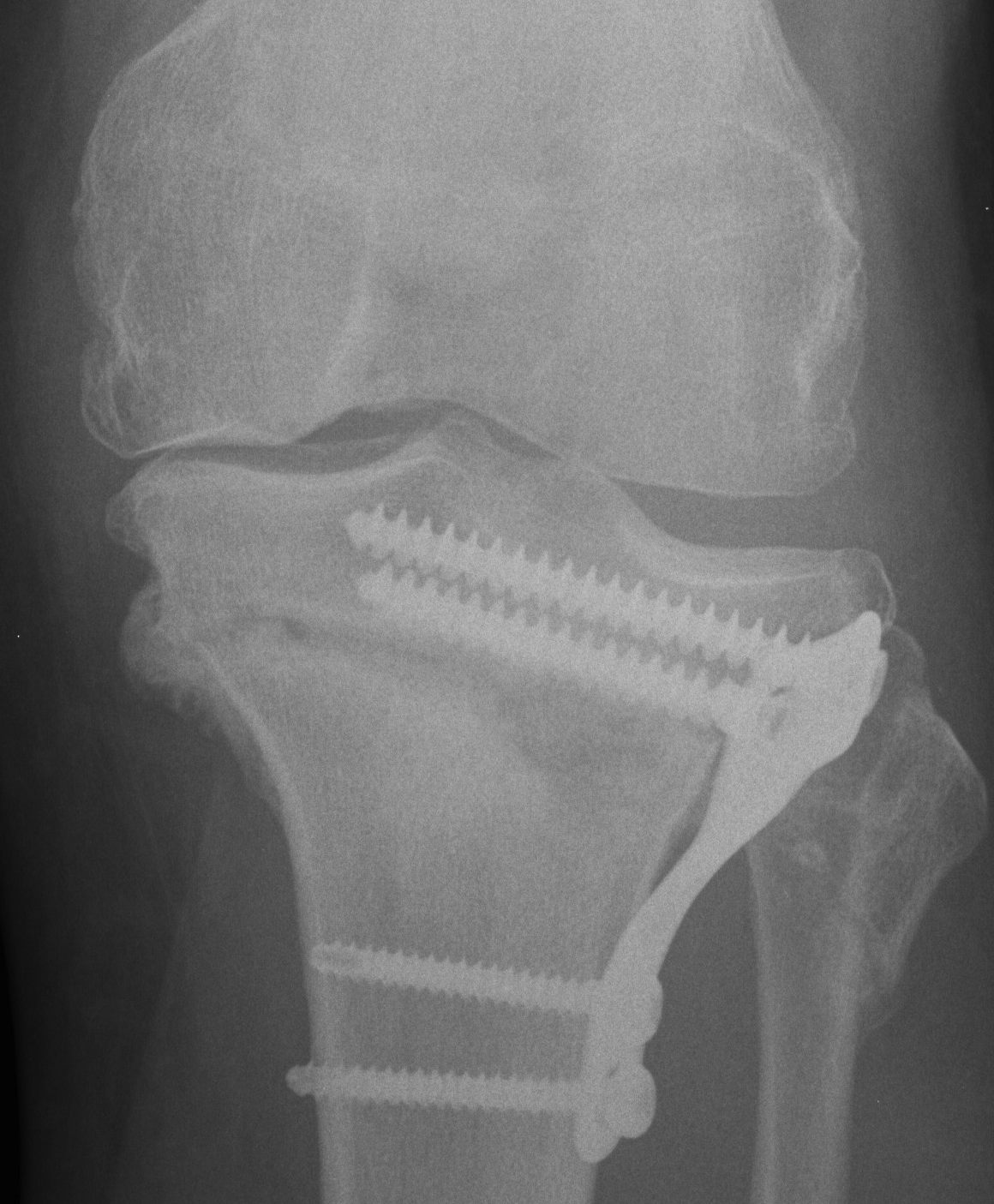 HTO Closing Wedge Medial Fracture Callous